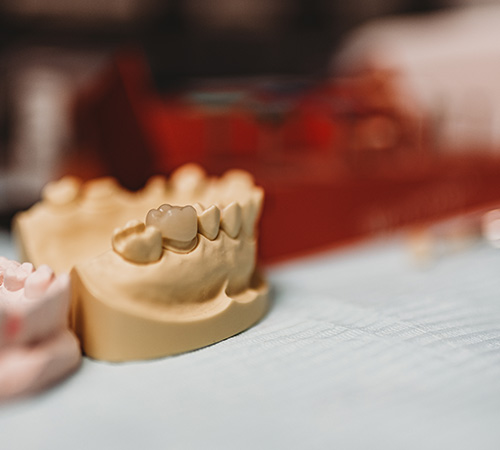 Dental Crowns In Houston TX