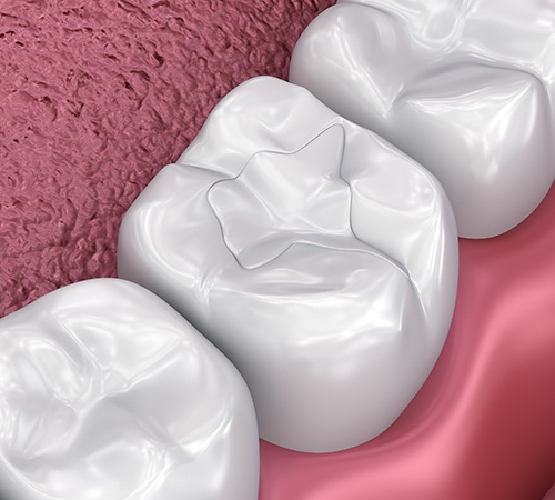 Tooth Colored Fillings In Houston TX