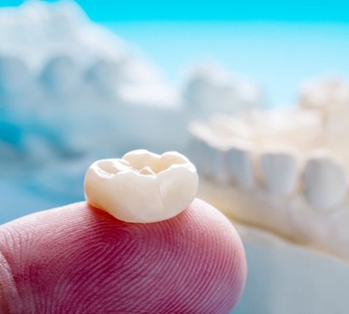 CEREC Same-Day Dental Crown Services In Houston TX
