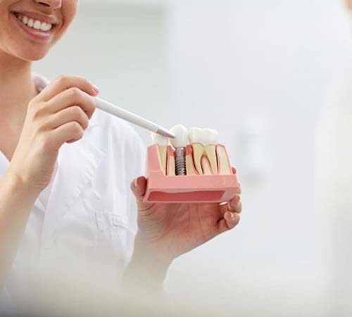 implant dentist in Houston showing a dental implant model to a patient