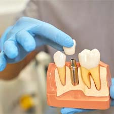 dentist placing a crown on a model of a dental implant