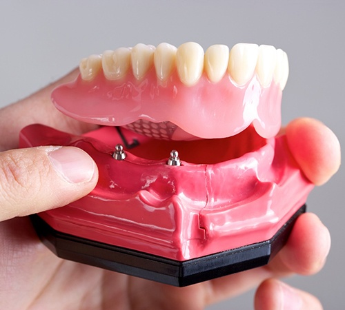 dentist holding a model of an implant denture