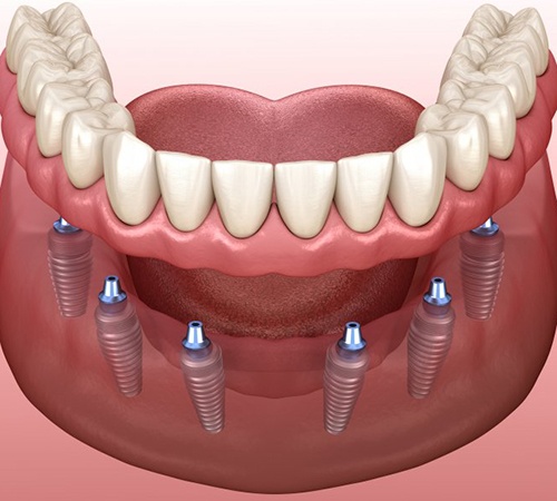 implant denture supported by six dental implants