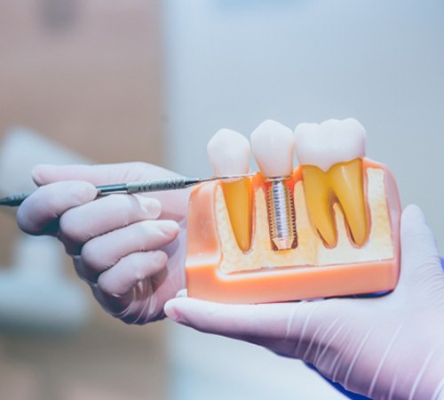 Dentist pointing to dental implant