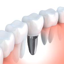 Diagram of an integrated dental implant in Houston