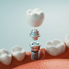 Animated implant supported dental crown placement