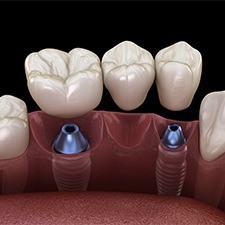 Animated implant supported fixed bridge placement