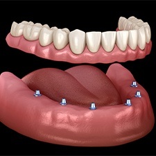 Animated implant supported denture placement