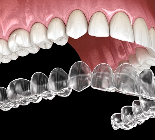 illustration for Invisalign in Houston