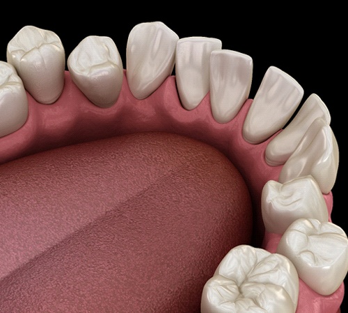 crooked teeth illustration for Invisalign in Houston
