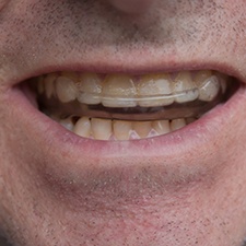 Closeup of man wearing a custom nightguard